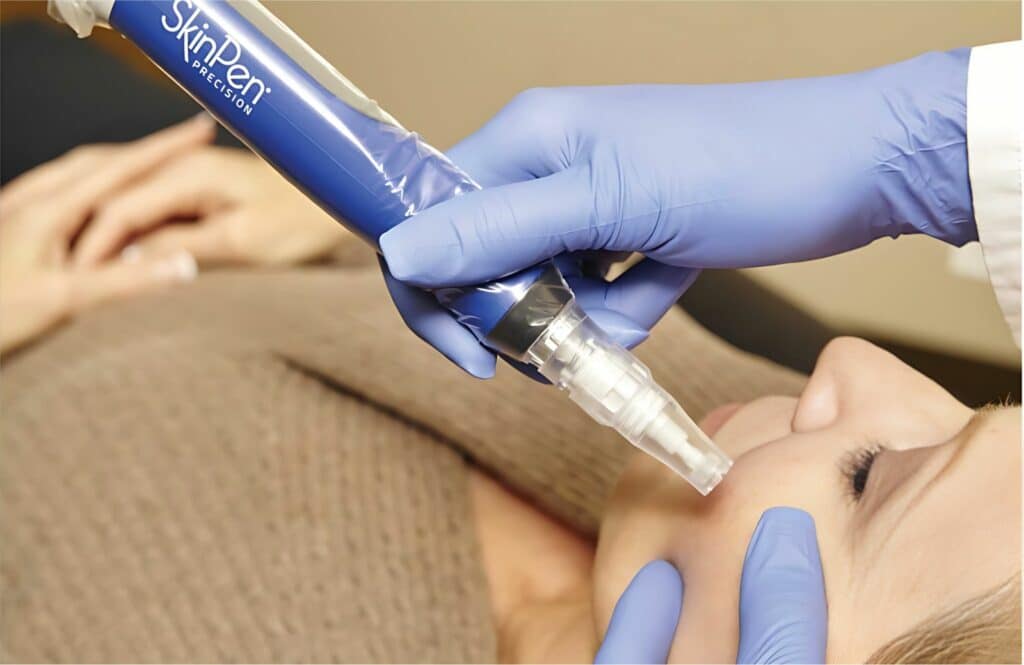 A person in blue gloves is using a microneedling device on another person's face during a skincare treatment, possibly in a medical or spa setting.