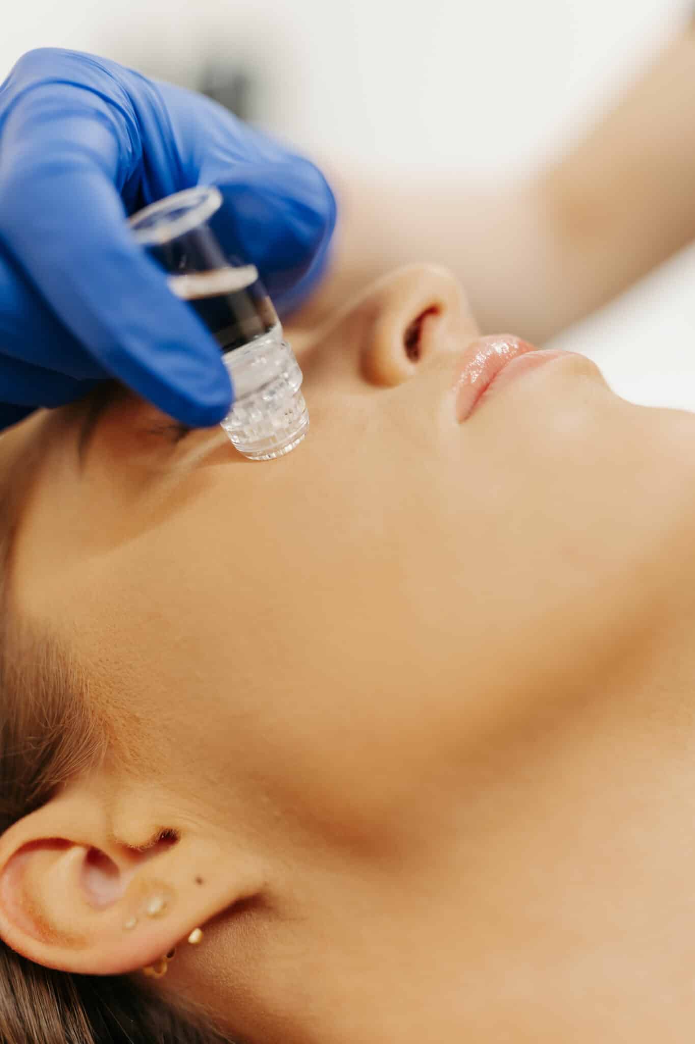 A person's face close-up with closed eyes, receiving treatment with a dermaroller held by a gloved hand, possibly during a skincare procedure.