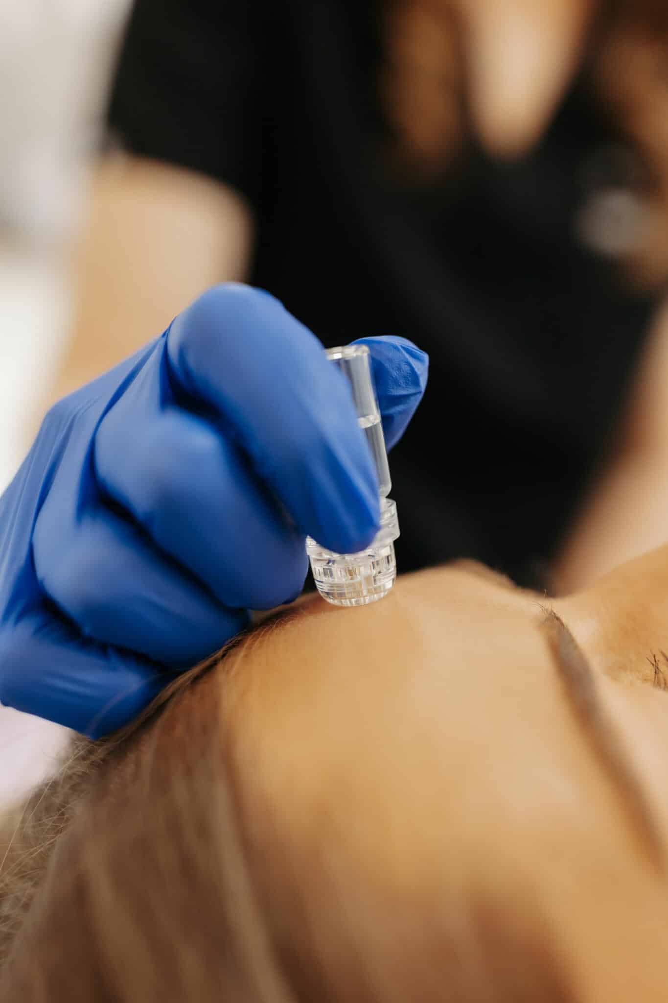 A person wearing blue gloves is holding a dermal roller against human skin for a skincare treatment, with a blurry background featuring a person.