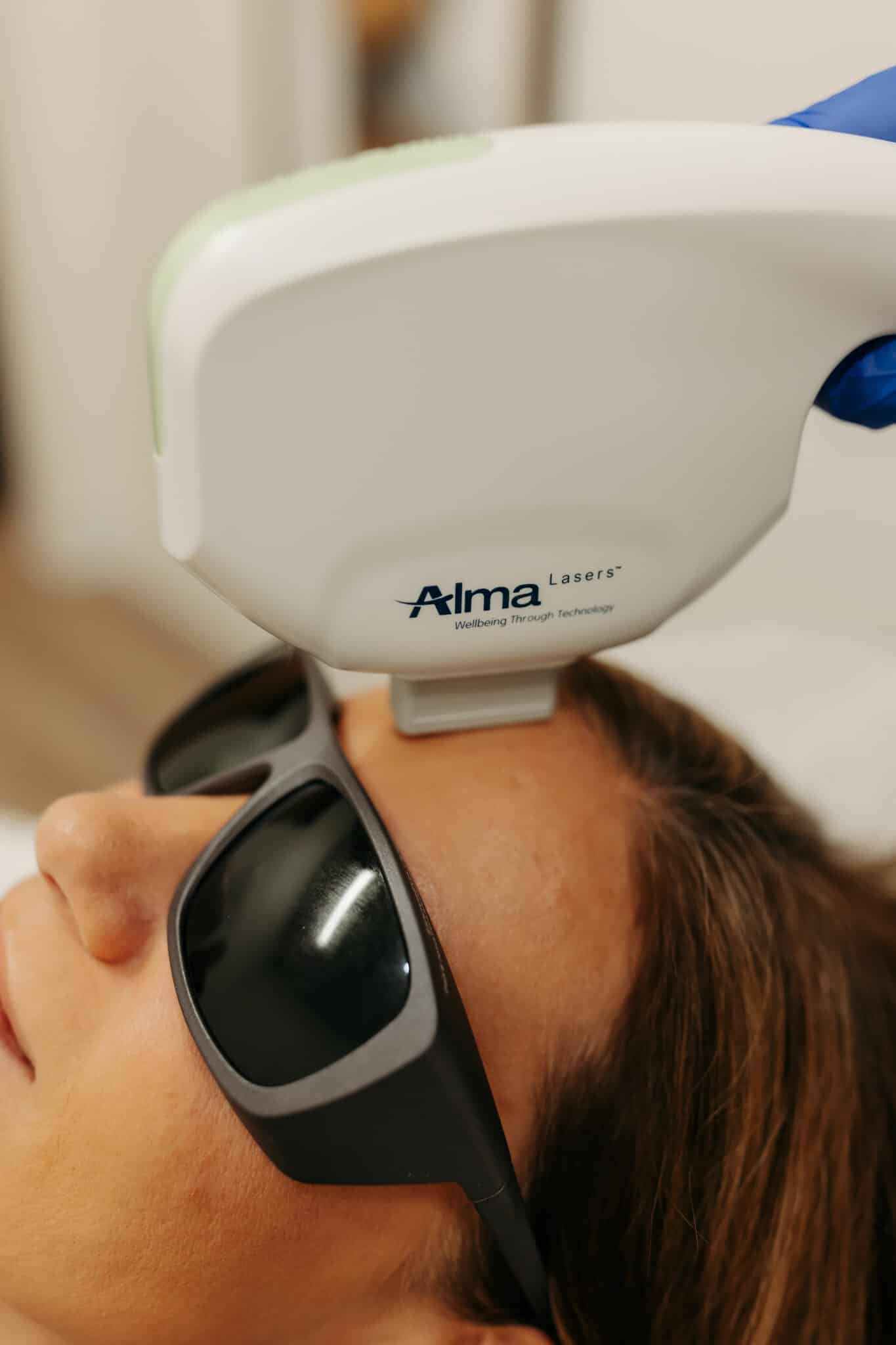 A person is lying down wearing protective eyewear while undergoing a laser treatment using an "Alma Lasers" device in a clinical setting.