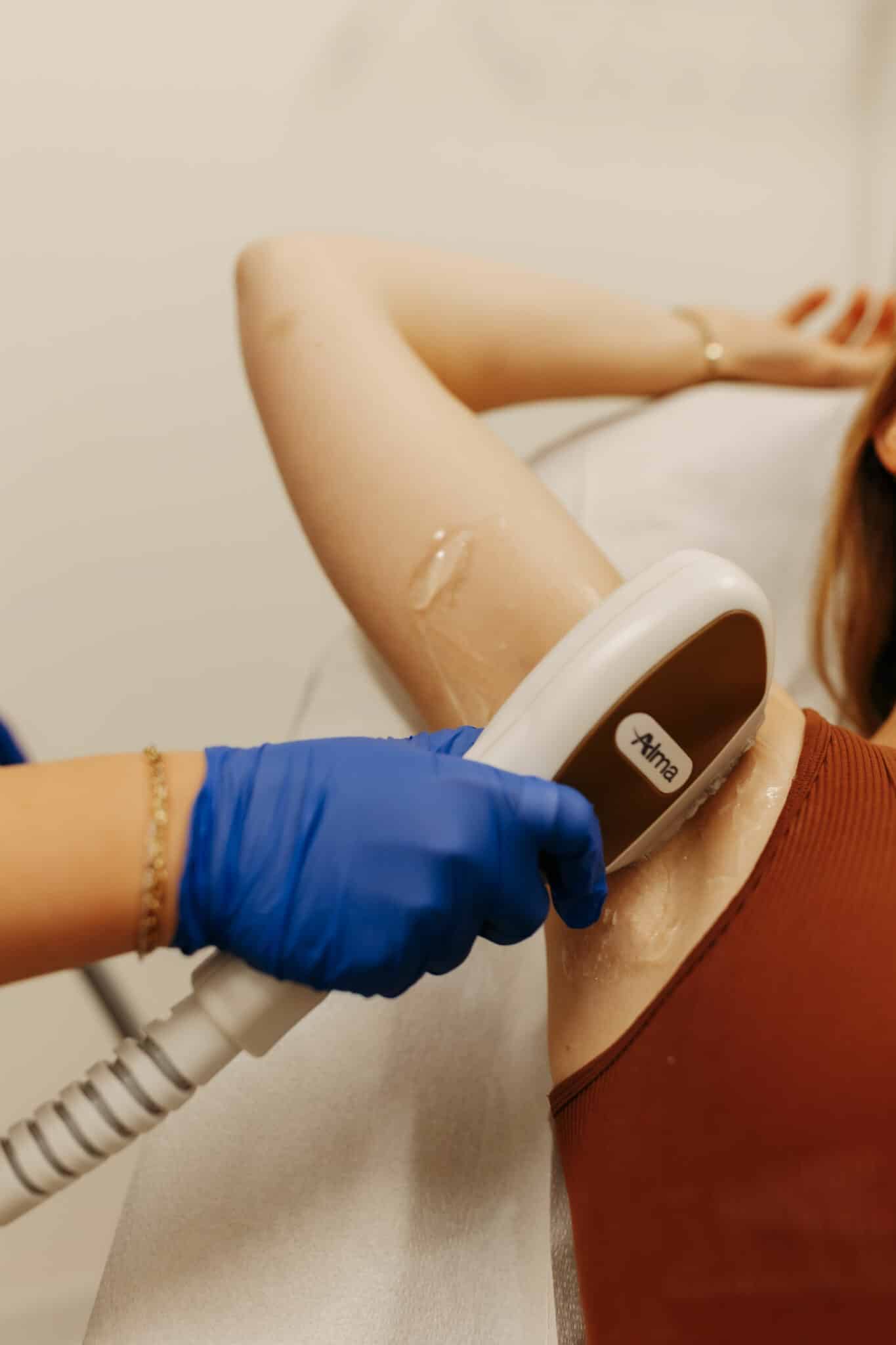 A person wearing blue gloves is operating a laser hair removal device on another person's underarm area in a clinical setting.