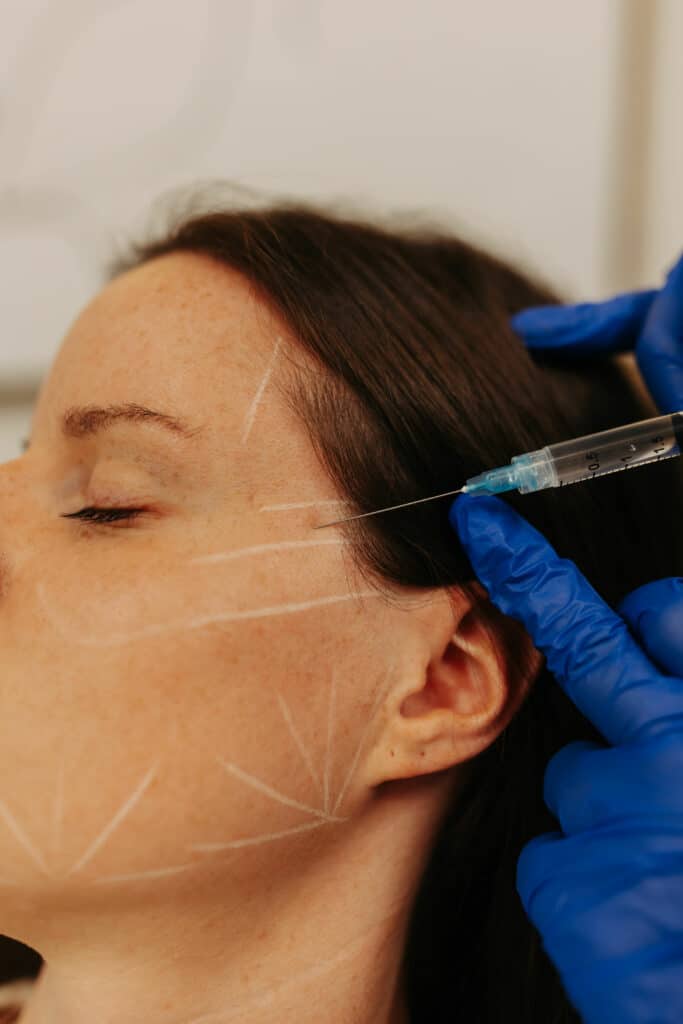 A person is receiving an injection in the face, with white markings drawn on the skin, while someone wearing blue gloves performs the procedure.