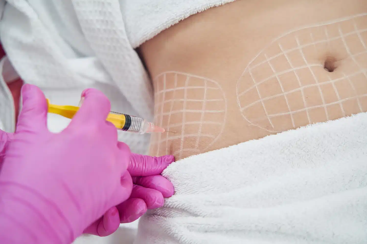 A person is undergoing a cosmetic procedure with marked skin and a hand in pink gloves administering an injection. White towels and a serene environment suggest a clinic.