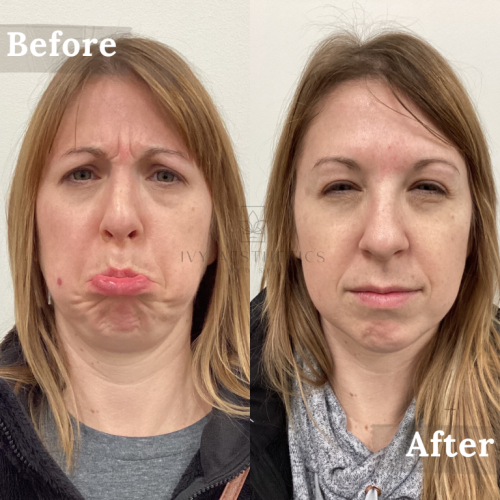 The image is a split comparison labeled "Before" and "After" showing a person's facial expression change from displeased or distressed to neutral or tired.