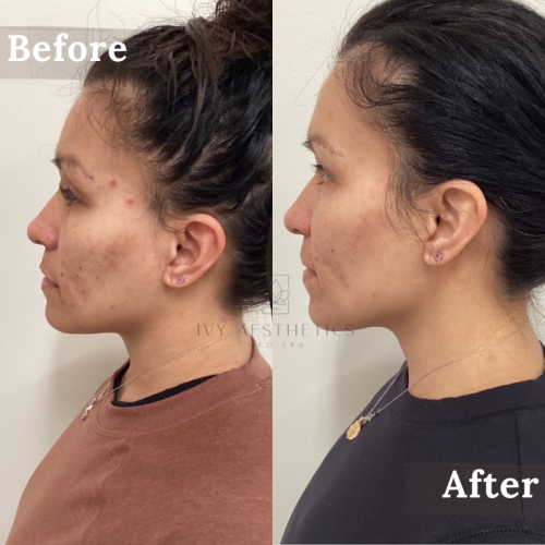 The image shows a side-by-side comparison of a person's profile before and after aesthetic treatment, indicating improved skin clarity and reduced blemishes.