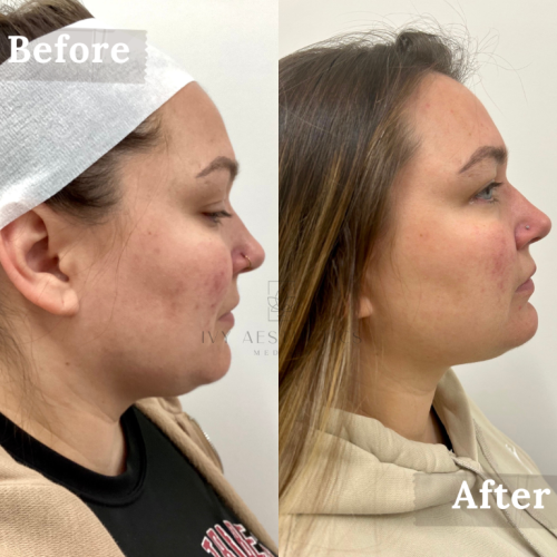 The image shows a side-by-side comparison of a person's profile with text "Before" and "After," potentially indicating a cosmetic or medical treatment outcome.