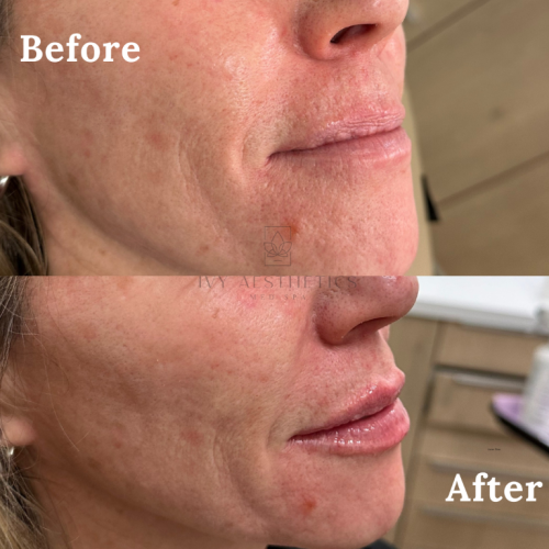 The image is a split-view of a person's lower face, highlighting "Before" and "After" results, possibly from a cosmetic or dermatological treatment.