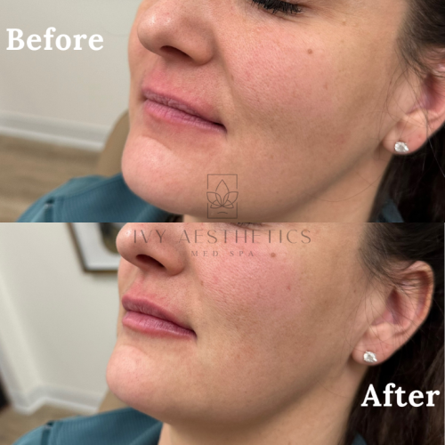The image shows a side-by-side comparison of a person's lower face profile labeled "Before" and "After," likely illustrating the results of a cosmetic skin treatment.