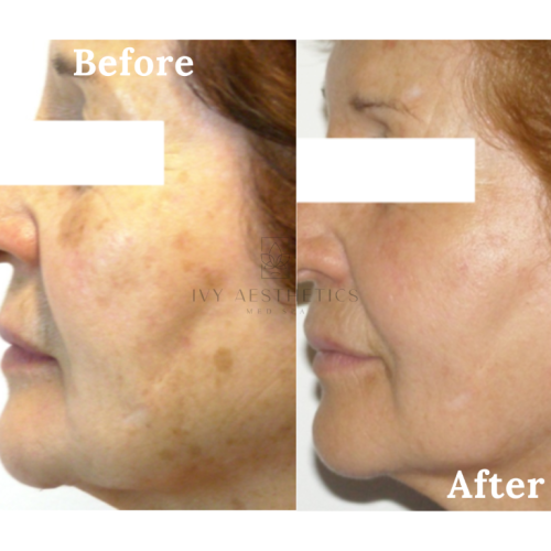 The image displays a split-view comparison of a person's profile marked "Before" and "After," showing skin improvement, possibly from a cosmetic treatment or skincare regimen.