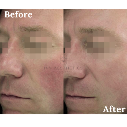 The image shows a split view of a person's face marked "Before" and "After" for a comparison, likely demonstrating the results of a skincare or medical treatment.