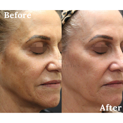 Before-and-after profile shots of a person, showing cosmetic or dermatological treatment results. Post-procedure, the skin appears smoother and more youthful.
