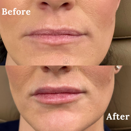 The image displays a close-up comparison of a person's mouth area, before and after an aesthetic treatment, showing more defined and slightly fuller lips in the after photo.