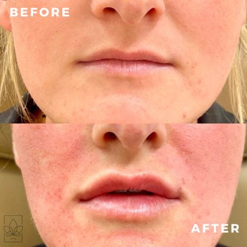 The image displays the lower half of a person's face before and after skin treatment, showing clearer skin and reduced blemishes in the after photo.