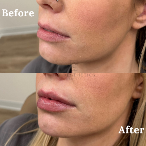 The image shows a split-view comparison labeled "Before" and "After," displaying a person's lower face with enhanced lip fullness and definition in the after photo.