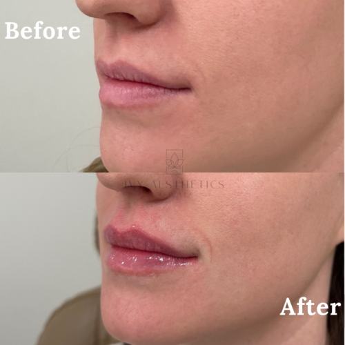 The image shows a close-up comparison of a person's lips and lower face labeled "Before" and "After," suggesting aesthetic treatments with noticeable fuller lips in the "After" photo.