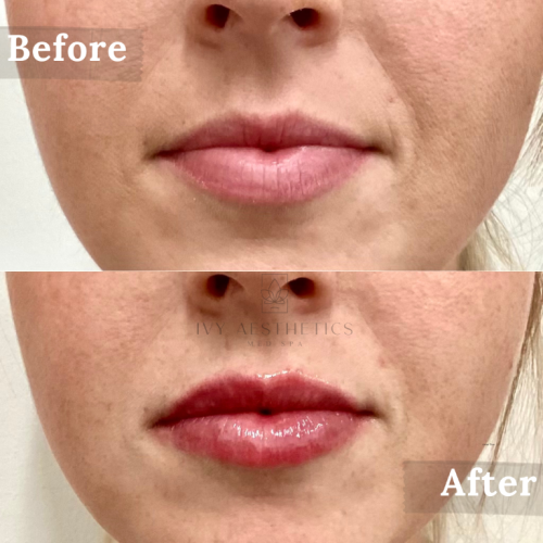 The image shows a person's lower face with 'Before' and 'After' comparisons, displaying enhanced and fuller lips likely post cosmetic treatment.