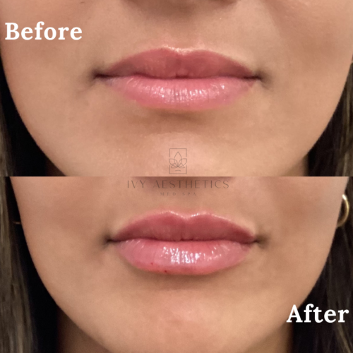 The image shows a close-up comparison of a person's lips before and after a cosmetic procedure, labeled "Before" and "After" with visibly plumper results.