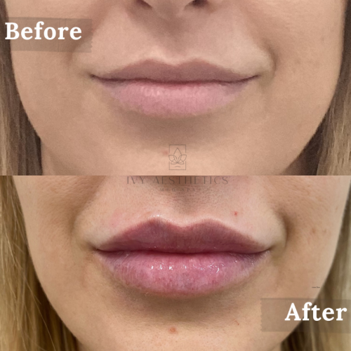 The image shows a close-up of a person's lower face, comparing lip appearance "Before" and "After" a cosmetic procedure, with increased lip volume and definition.