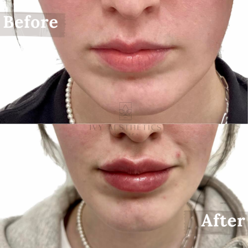 This image displays a split comparison labeled "Before" and "After" showing a person's lips, highlighting the results of a cosmetic or aesthetic treatment.