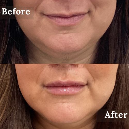 The image shows a close-up comparison of a person's lips before and after a cosmetic procedure, labeled respectively. The lower image features slightly fuller lips.