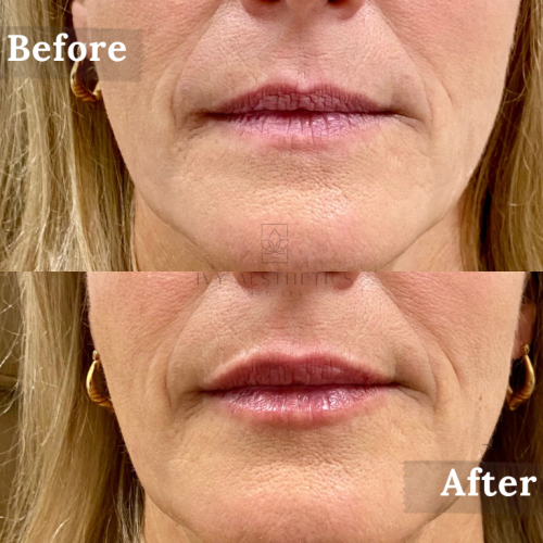 The image shows a split-view comparison of a person's lower face before and after a cosmetic procedure, demonstrating visible changes to the skin and lips.