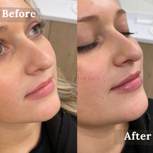 The image shows a side-by-side comparison of a person's profile before and after a cosmetic procedure, possibly lip enhancement, at a med spa.