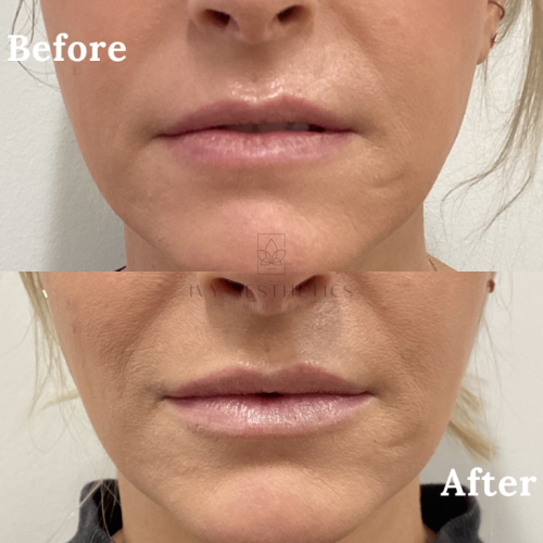 The image shows a split comparison of a person's lower face, labeled "Before" and "After," likely indicating cosmetic treatment results with enhanced lip fullness in the "After" photo.