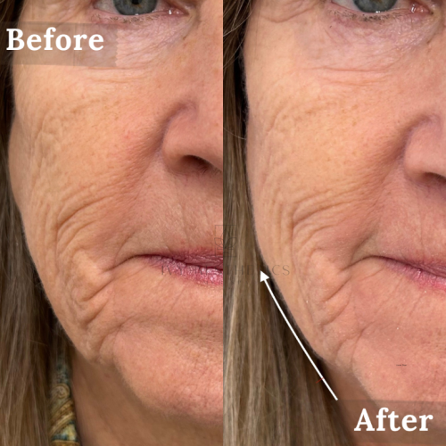 This image shows side-by-side close-ups of a person's face labeled "Before" and "After," highlighting the changes in skin texture and wrinkles.