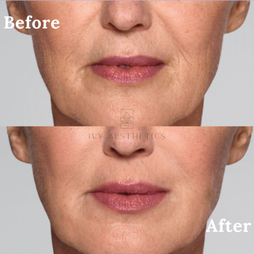 This is a split image showing a person's lower face marked "Before" and "After," likely illustrating the results of a cosmetic or aesthetic treatment.