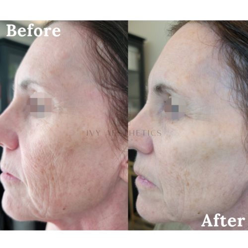 The image compares a person's profile with "Before" and "After" labels, showing skin texture improvement. Their eyes are pixelated for privacy. It's a medical spa context.