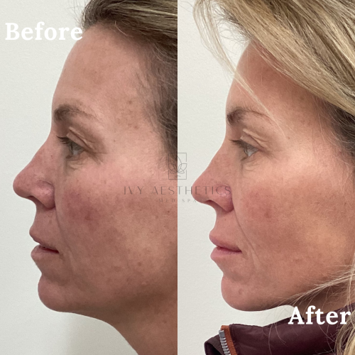 Side-by-side comparison of a person's profile labeled "Before" and "After," suggesting aesthetic changes, possibly from a medical spa treatment.