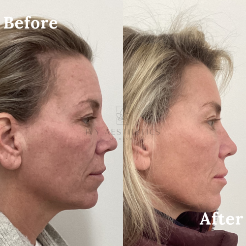 The image shows side-by-side profile views of a person labeled "Before" and "After," possibly to demonstrate the results of a cosmetic or medical treatment.