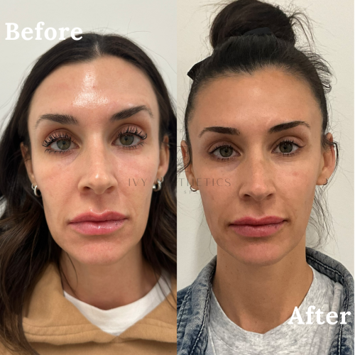 The image shows a split comparison of a person's face labeled "Before" and "After," possibly indicating changes from a cosmetic procedure or treatment.