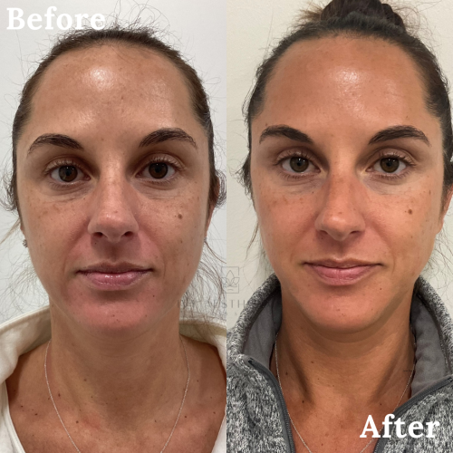 The image displays a split-screen comparison of a person's face labeled "Before" and "After," likely indicating the results of a skincare or cosmetic treatment.